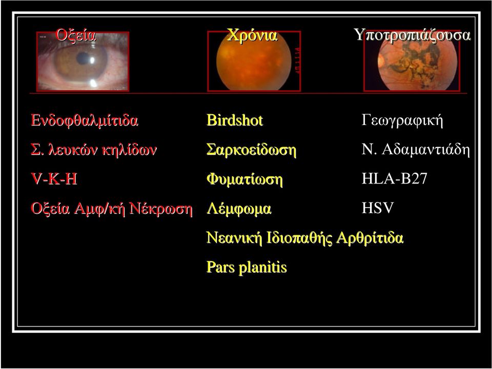 Βirdshotirdshot Σαρκοείδωση Φυµατίωση Λέµφωµα Νεανική