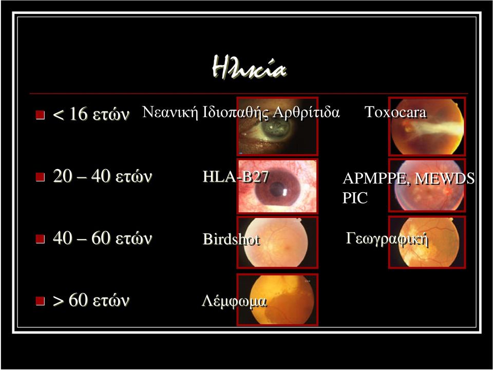 60 ετών HLA-B27 Birdshot APMPPE,