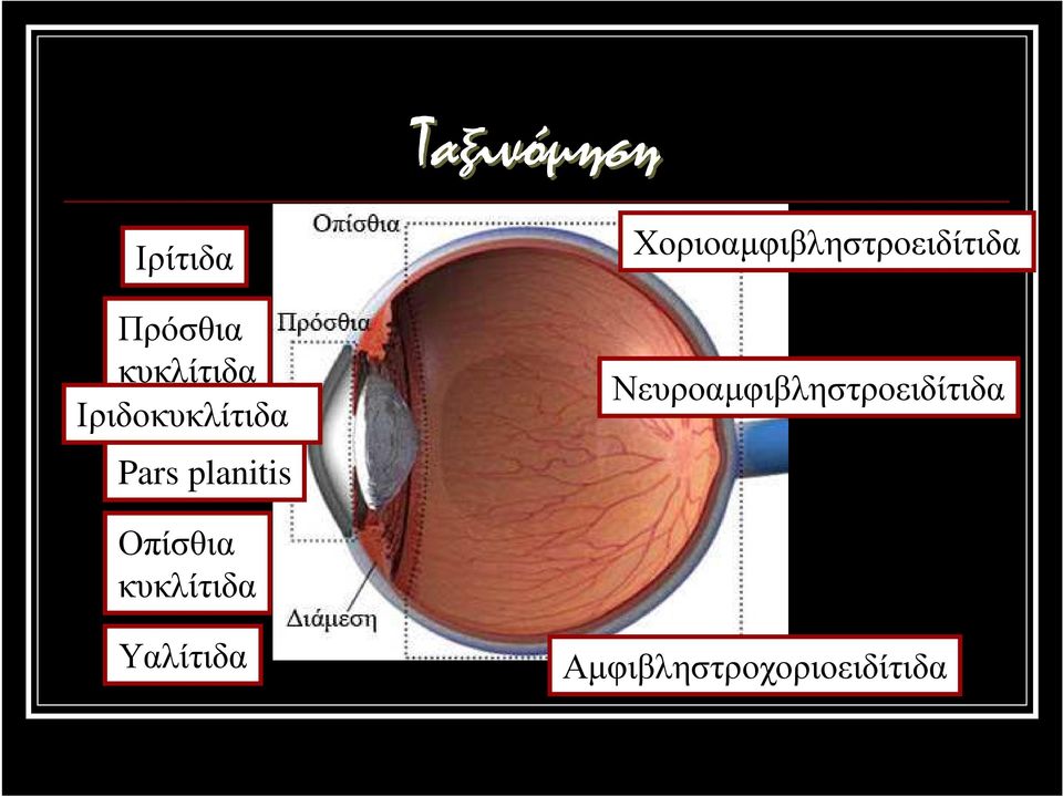 Χοριοαµφιβληστροειδίτιδα