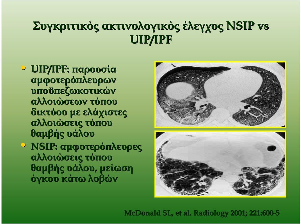 αλλοιώσεις τύπου θαμβής υάλου NSIP: αμφοτερόπλευρες αλλοιώσεις τύπου