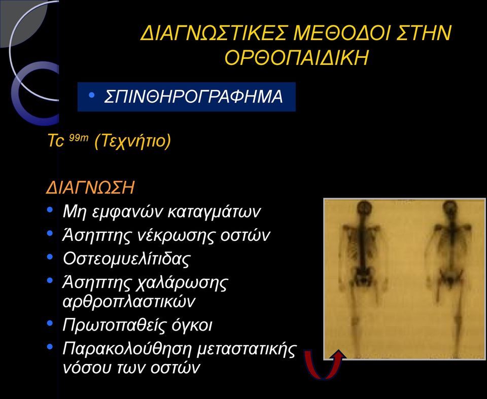 Οστεομυελίτιδας Άσηπτης χαλάρωσης αρθροπλαστικών