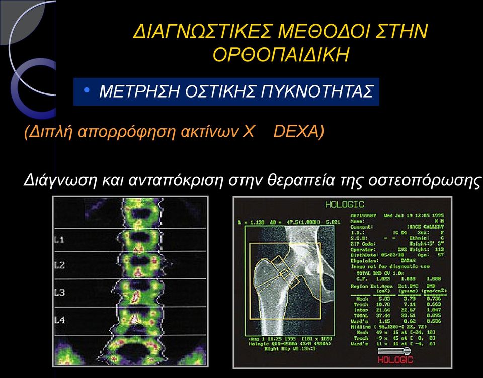 DEXA) Διάγνωση και