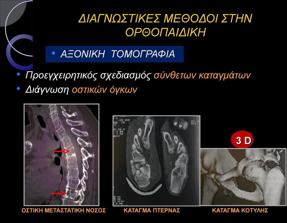 Διάγνωση οστικών όγκων 3D ΟΣΤΙΚΗ