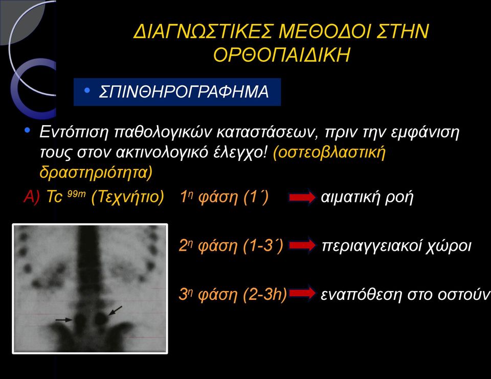 (οστεοβλαστική δραστηριότητα) Α) Tc 99m (Τεχνήτιο) 1η φάση (1