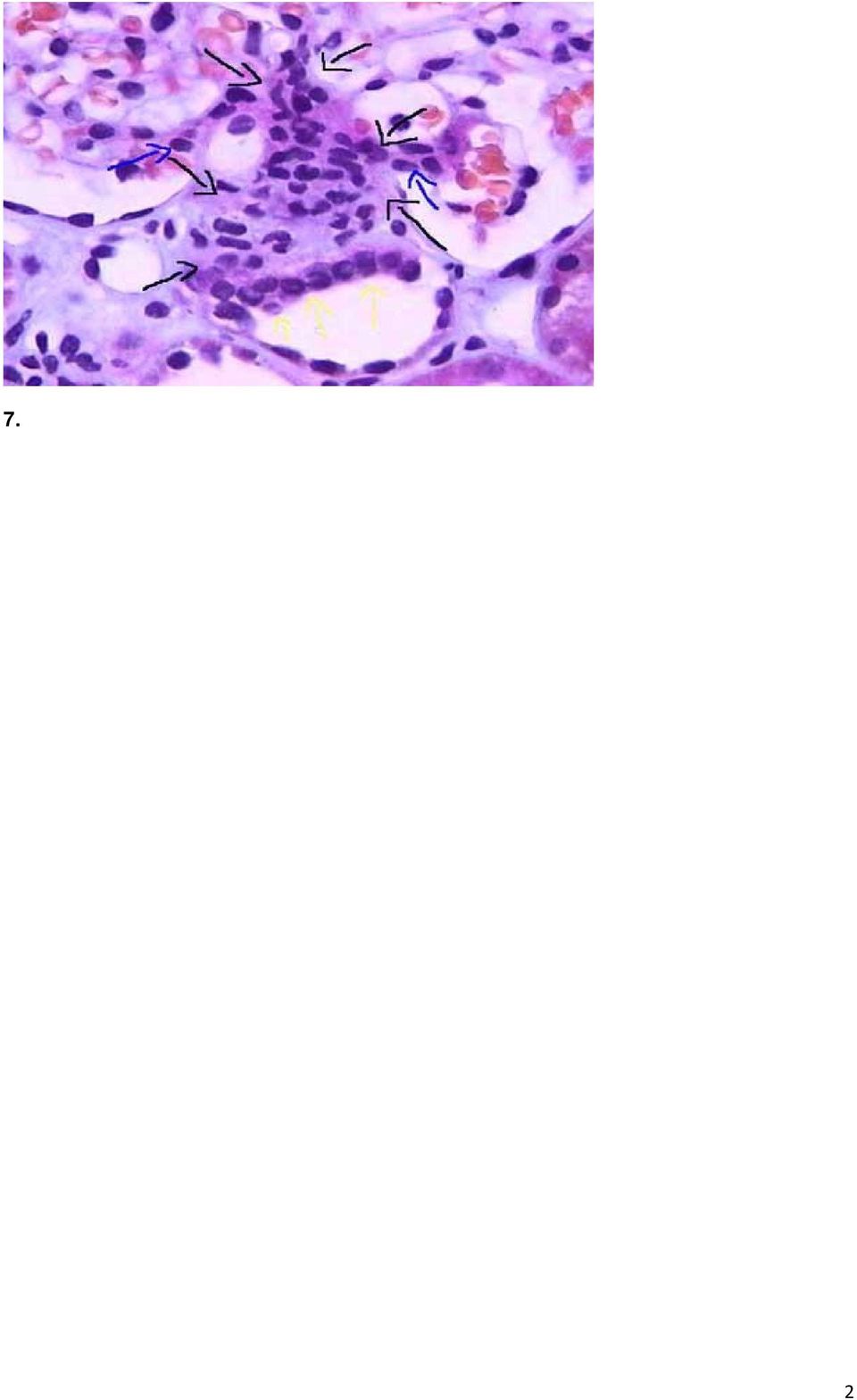 διαφορική διάγνωση (σε πτωματική μεταμόσχευση) μεταξύ οξείας σωληναριακής νέκρωσης και άλλων αιτίων πρώιμης δυσλειτουργίας του μοσχεύματος Γ.