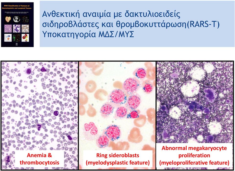 thrombocytosis Ring sideroblasts (myelodysplastic