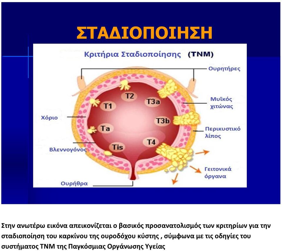 σταδιοποίηση του καρκίνου της ουροδόχου κύστης,
