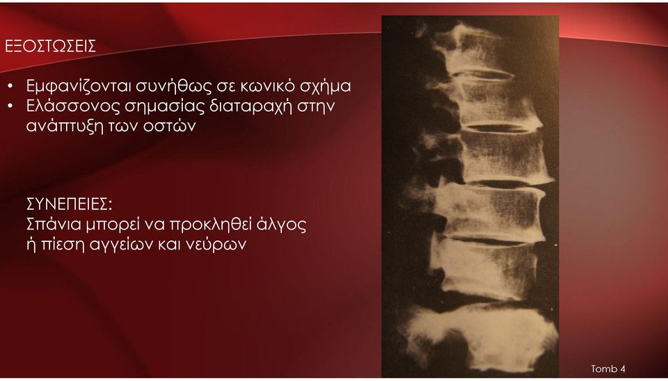 ανάπτυξη των οστών ΣΥΝΕΠΕΙΕΣ: Σπάνια μπορεί