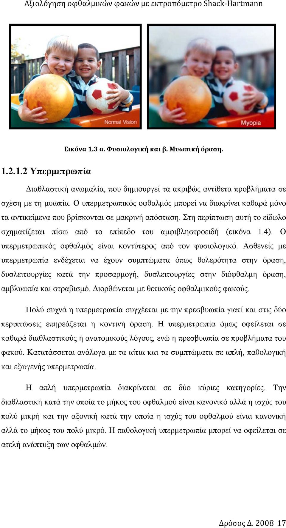 Στη περίπτωση αυτή το είδωλο σχηματίζεται πίσω από το επίπεδο του αμφιβληστροειδή (εικόνα 1.4). Ο υπερμετρωπικός οφθαλμός είναι κοντύτερος από τον φυσιολογικό.