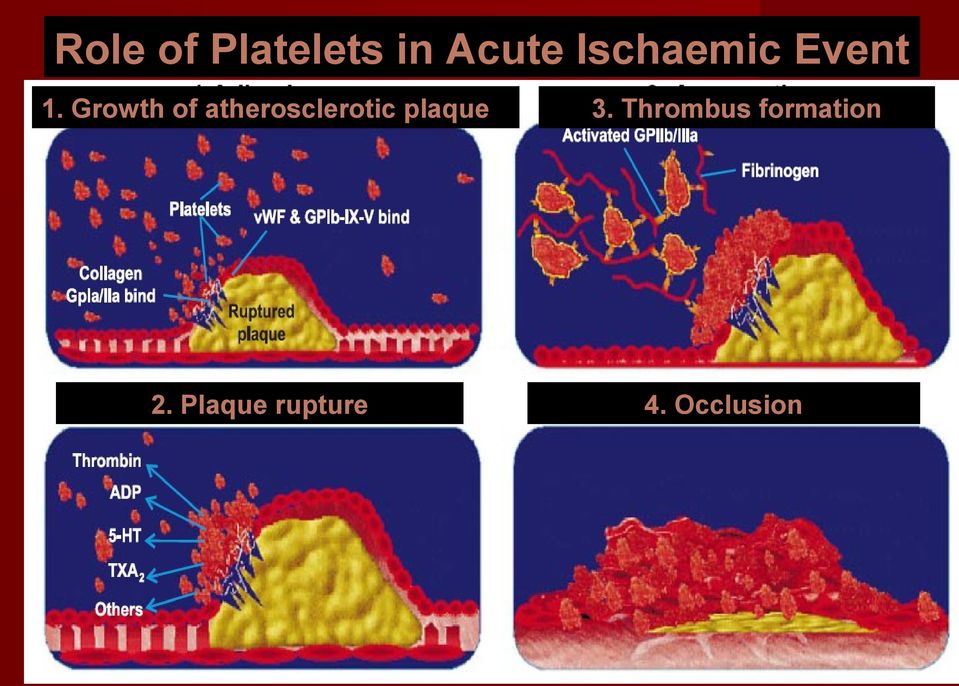 Growth of atherosclerotic plaque