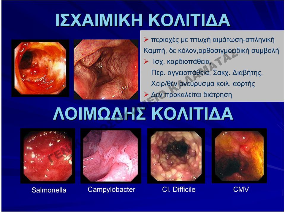 αγγειοπάθεια, Σακχ. Διαβήτης, Χειρ/θέν ανεύρυσμα κοιλ.