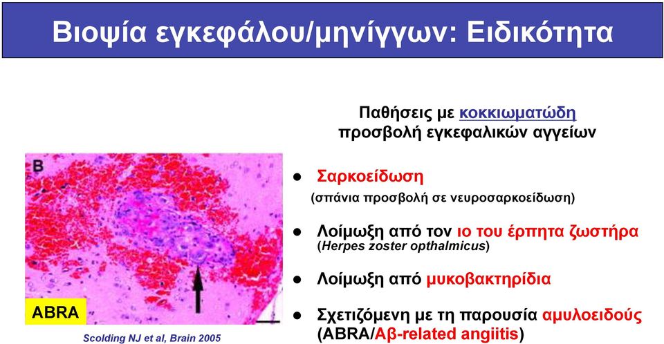 νευροσαρκοείδωση) Λοίµωξη από τον ιο του έρπητα ζωστήρα (Herpes zoster opthalmicus)