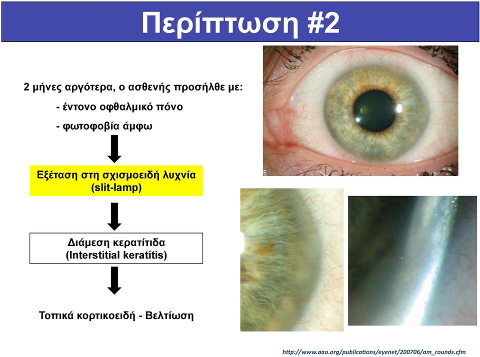 (slit-lamp) Διάµεση κερατίτιδα (Interstitial keratitis) Τοπικά