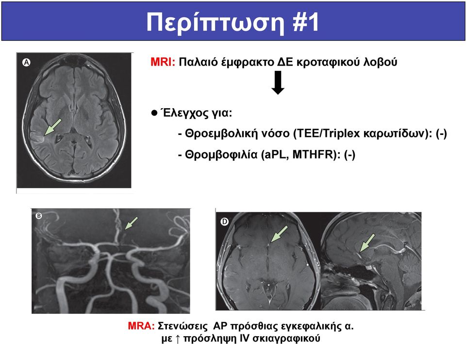 καρωτίδων): (-) - Θροµβοφιλία (apl, MTHFR): (-) MRΑ: