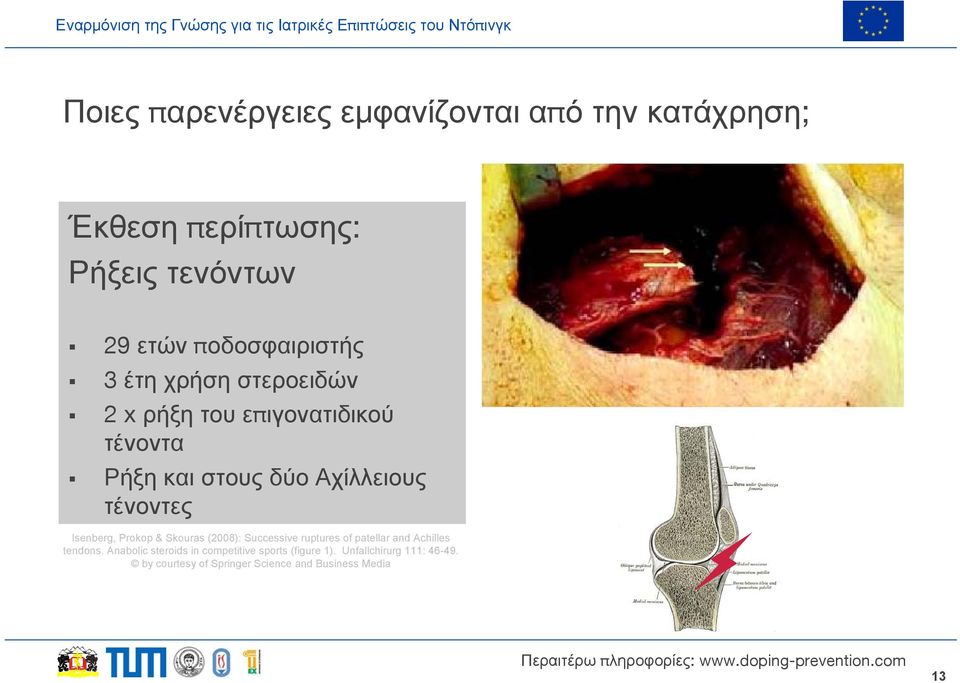 τένοντες Isenberg, Prokop & Skouras (2008): Successive ruptures of patellar and Achilles tendons.