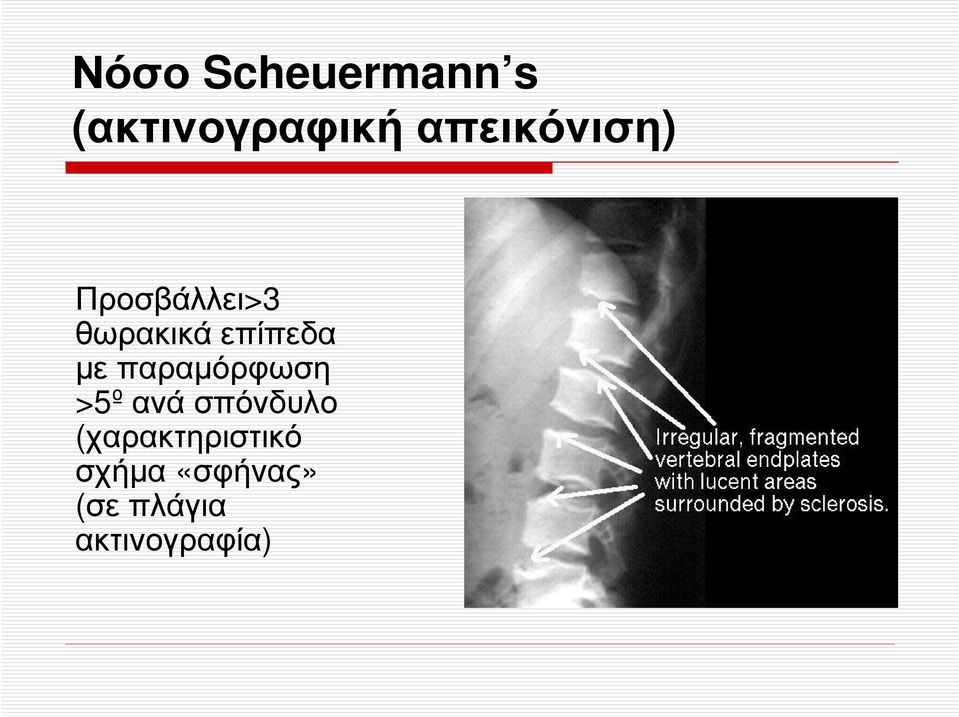 επίπεδα µε παραµόρφωση >5ºανάσπόνδυλο