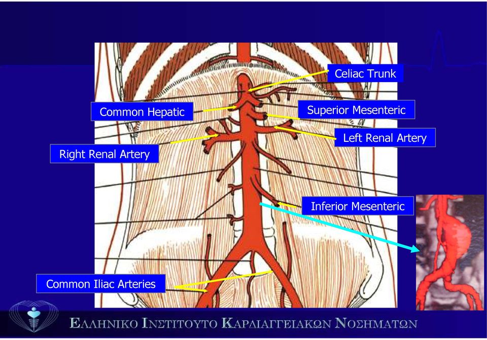 Mesenteric Left Renal Artery