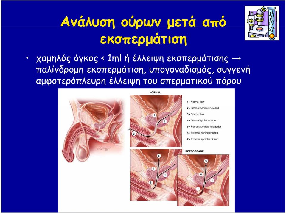 εκσπερμάτισης παλίνδρομη εκσπερμάτιση,