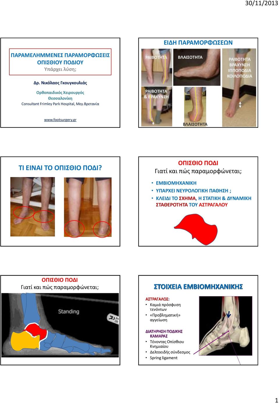 Βρετανία ΡΑΙΒΟΤΗΤΑ & ΒΡΑΧΥΝΣΗ www.footsurgery.gr ΒΛΑΙΣΟΤΗΤΑ ΤΙ ΕΙΝΑΙ ΤΟ ΟΠΙΣΘΙΟ ΠΟΔΙ?