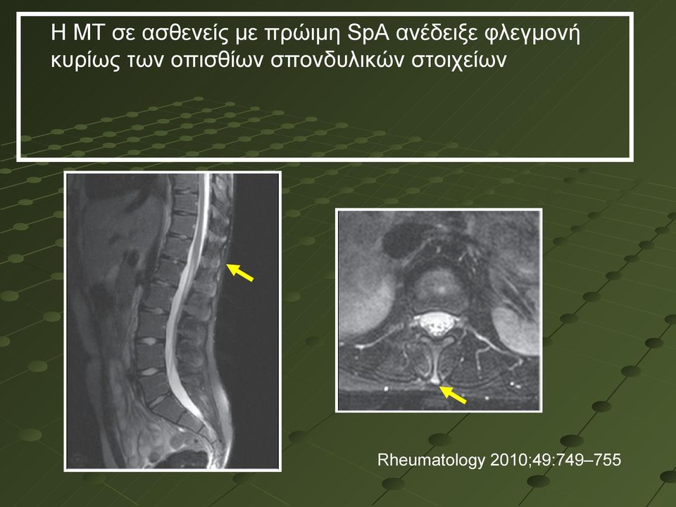 των οπισθίων σπονδυλικών