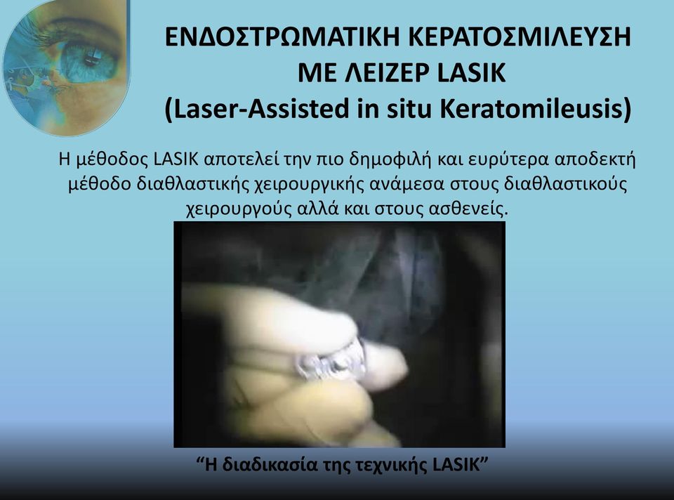 ευρύτερα αποδεκτή μέθοδο διαθλαστικής χειρουργικής ανάμεσα στους