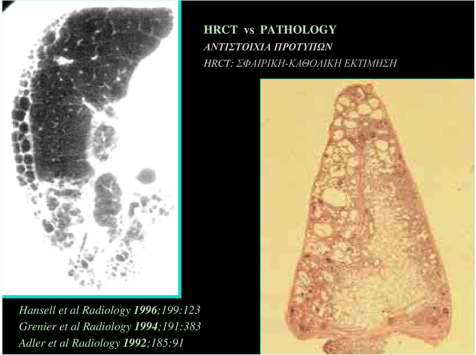 Radiology 1996;199:123 Grenier et al