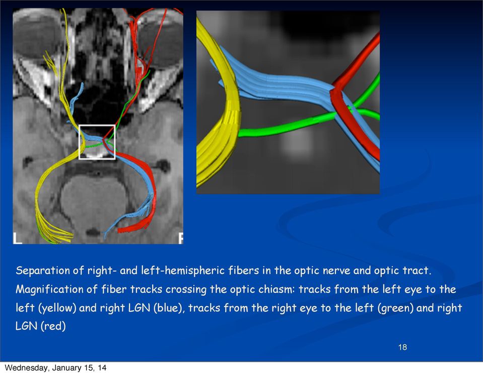 Magnification of fiber tracks crossing the optic chiasm: tracks from