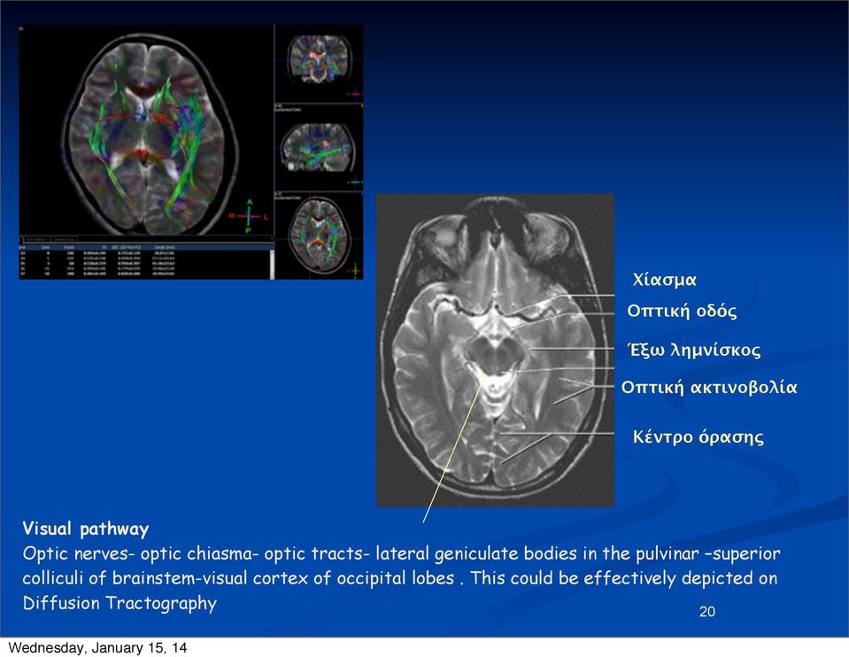 bodies in the pulvinar superior colliculi of brainstem-visual cortex of