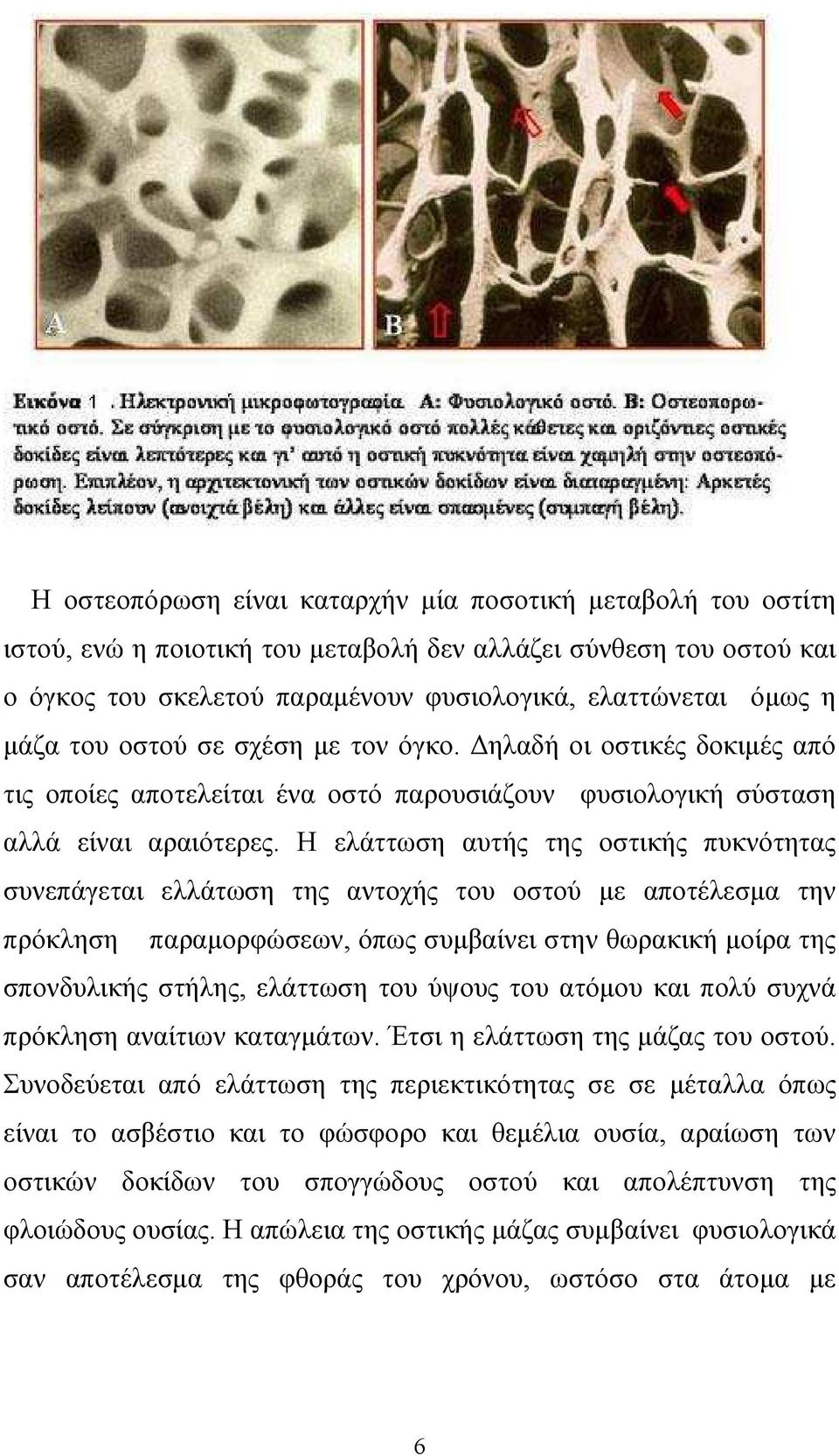 Η ελάττωση αυτής της οστικής πυκνότητας συνεπάγεται ελλάτωση της αντοχής του οστού µε αποτέλεσµα την πρόκληση παραµορφώσεων, όπως συµβαίνει στην θωρακική µοίρα της σπονδυλικής στήλης, ελάττωση του