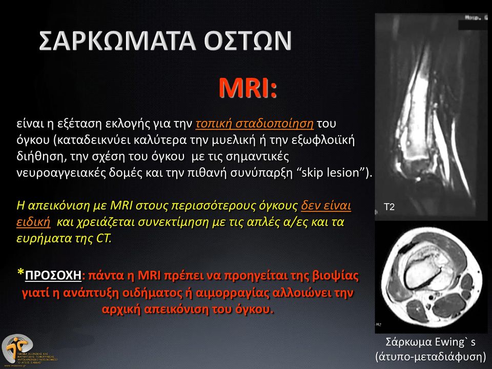 Η απεικόνιση με MRI στους περισσότερους όγκους δεν είναι ειδική και χρειάζεται συνεκτίμηση με τις απλές α/ες και τα ευρήματα της CT.