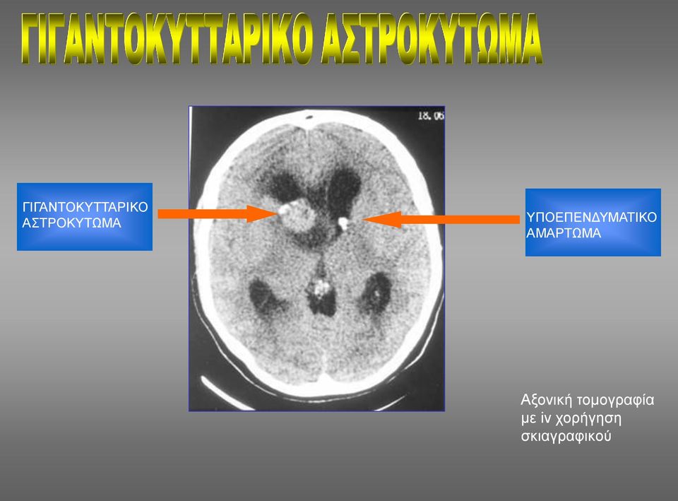 ΥΠΟΕΠΕΝΔΥΜΑΤΙΚΟ ΑΜΑΡΤΩΜΑ