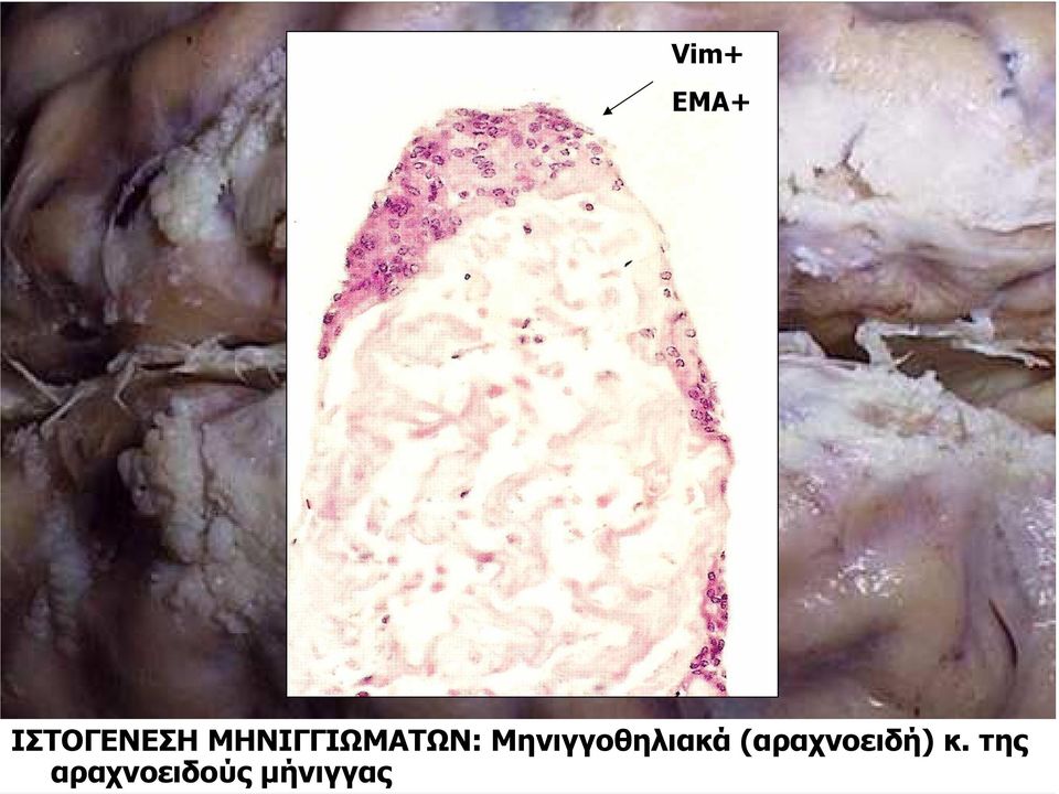 Μηνιγγοθηλιακά