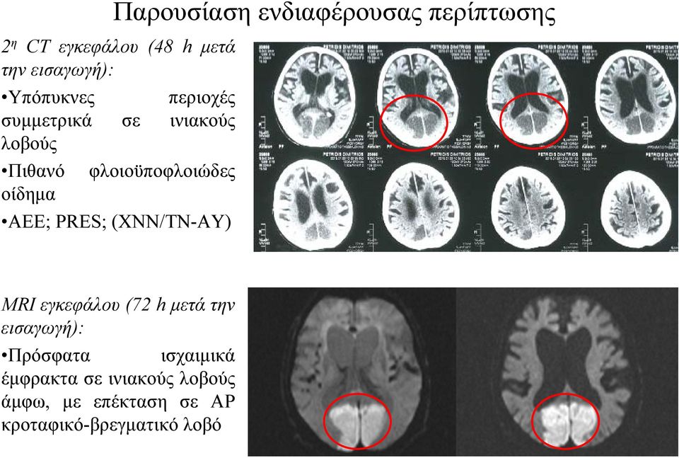 ΑΕΕ; PRES; (ΧΝΝ/ΤΝ-ΑΥ) MRI εγκεφάλου (72 h μετά την εισαγωγή): Πρόσφατα