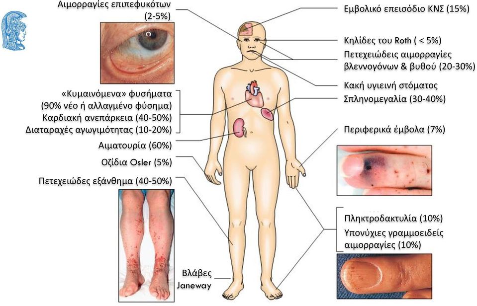 Διαταραχές αγωγιμότητας (10-20%) Αιματουρία (60%) Κακή υγιεινή στόματος Σπληνομεγαλία (30-40%) Περιφερικά έμβολα