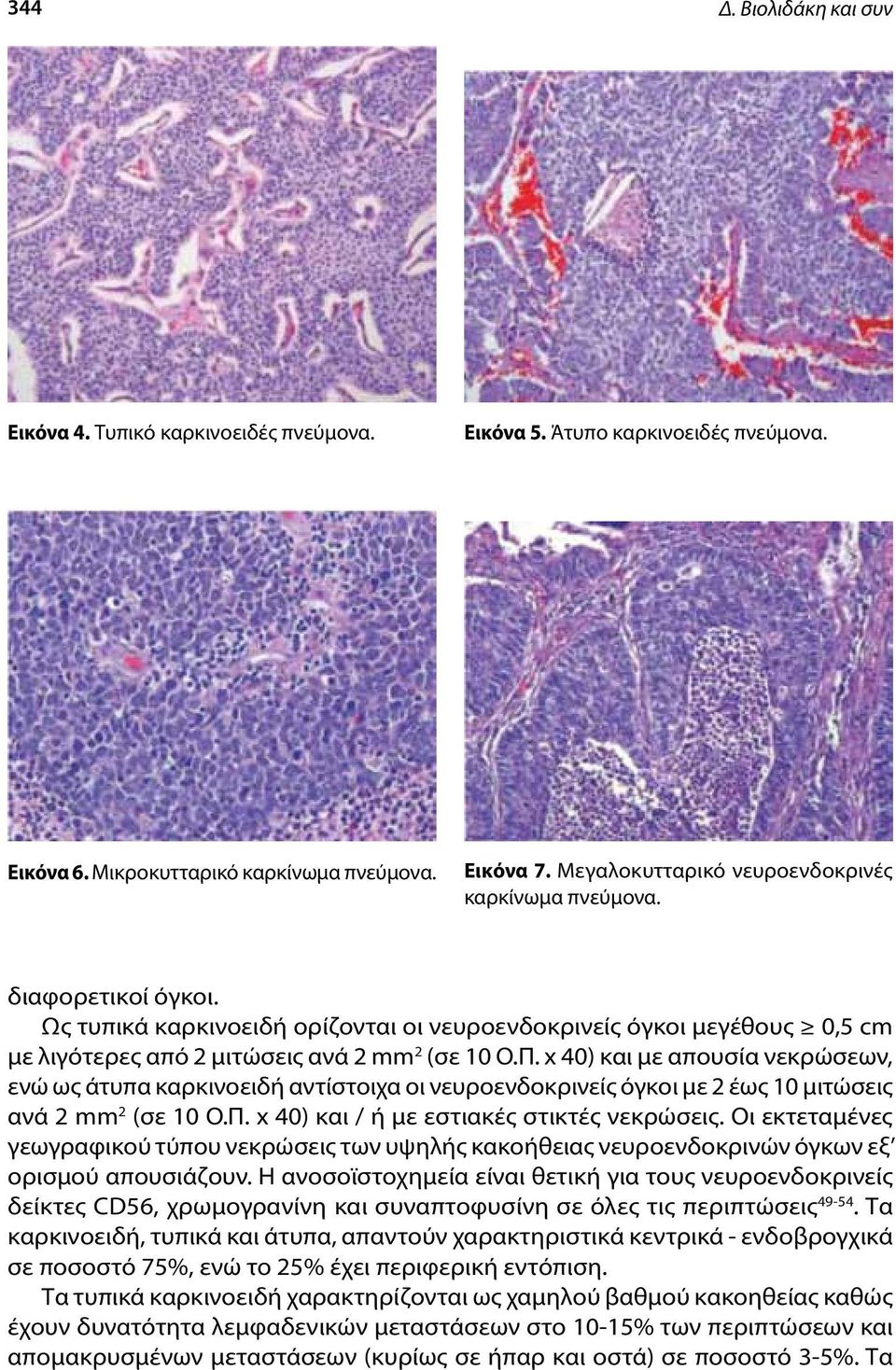 x 40) και με απουσία νεκρώσεων, ενώ ως άτυπα καρκινοειδή αντίστοιχα οι νευροενδοκρινείς όγκοι με 2 έως 10 μιτώσεις ανά 2 mm 2 (σε 10 Ο.Π. x 40) και / ή με εστιακές στικτές νεκρώσεις.