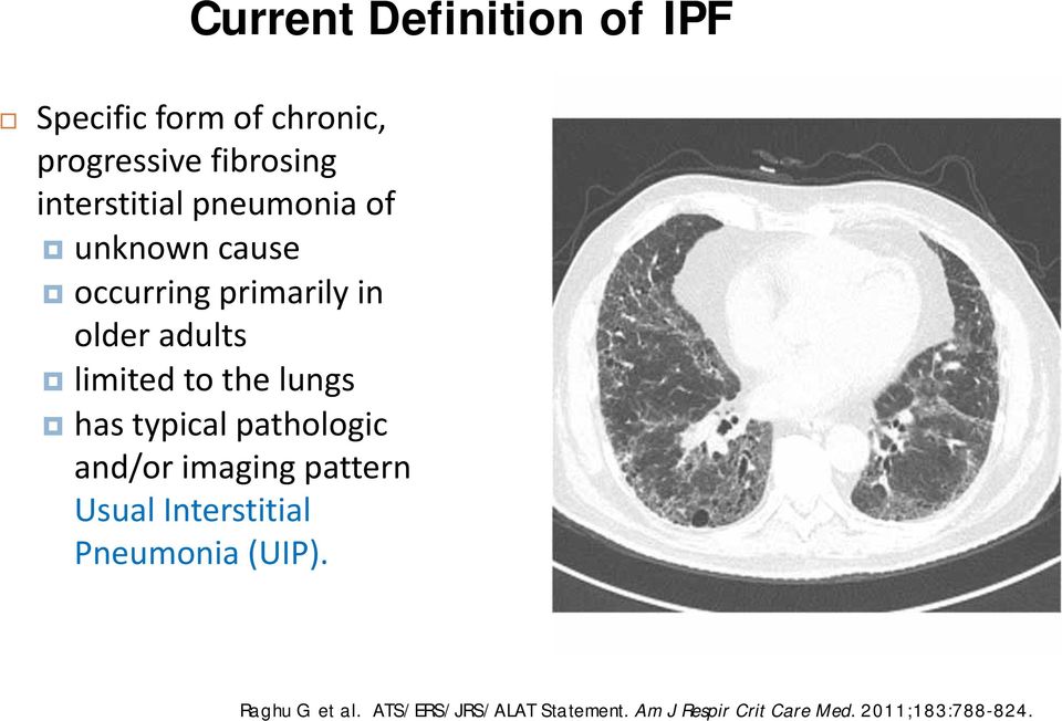 to the lungs has typical pathologic and/or imaging pattern Usual Interstitial
