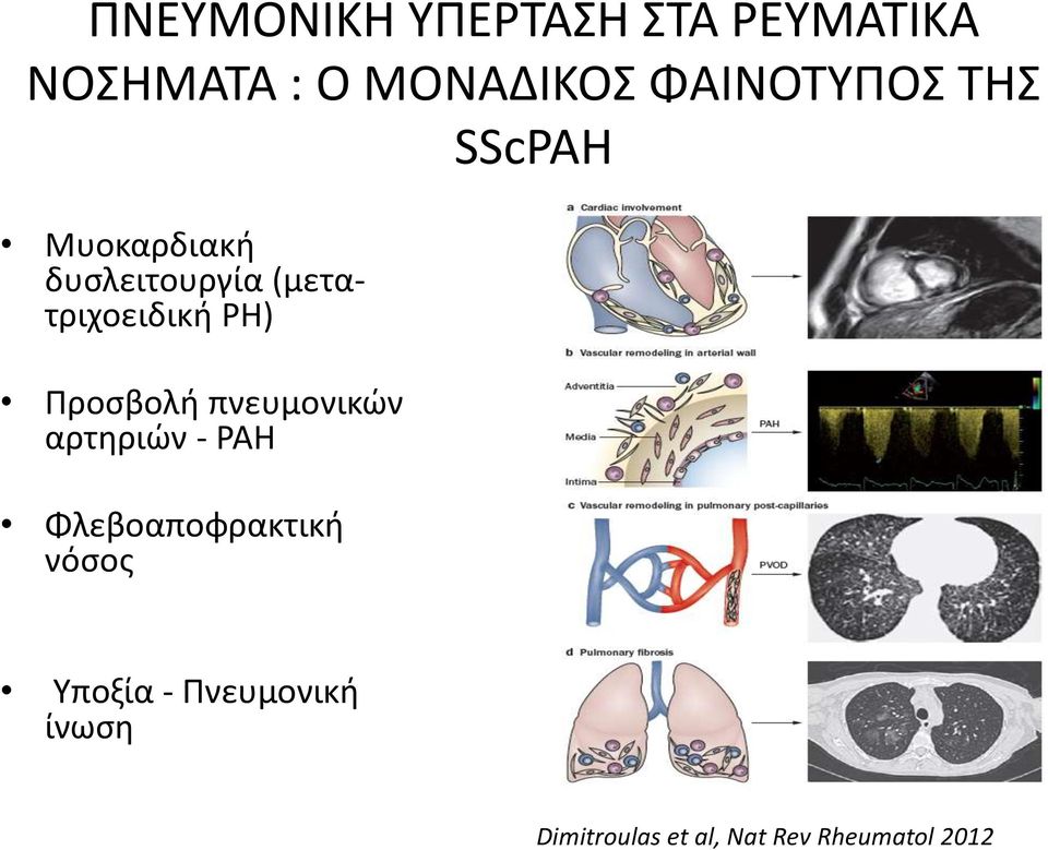 (μετατριχοειδική PH) Προσβολή πνευμονικών αρτηριών - PAH