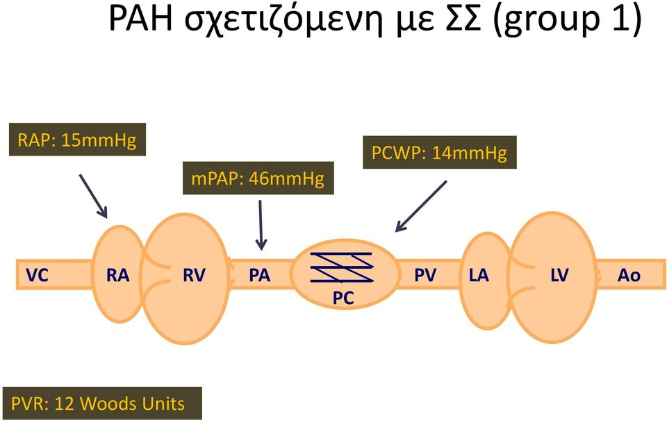 PCWP: 14mmHg VC RA RV PA PV