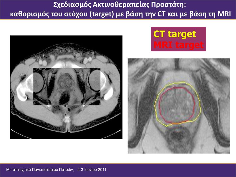 στόχου (target) με βάση την CT