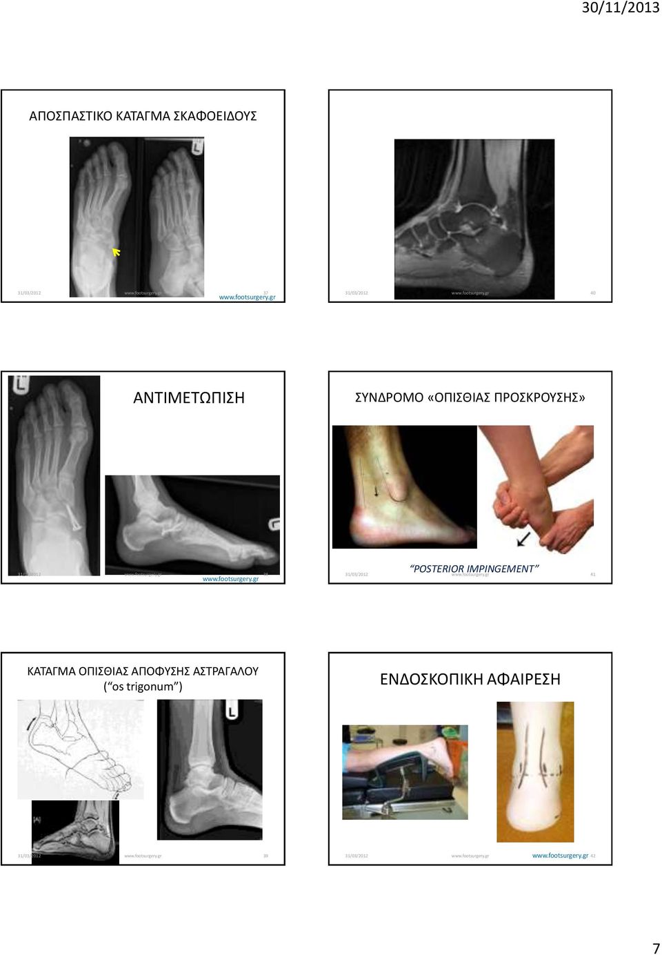 POSTERIOR IMPINGEMENT 41 ΚΑΤΑΓΜΑ ΟΠΙΣΘΙΑΣ