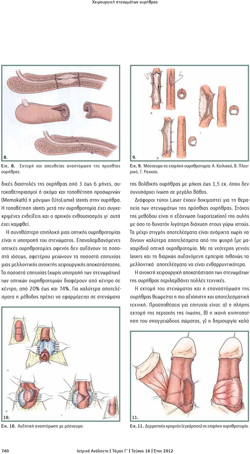 Η τοποθέτηση stents μετά την ουρηθροτομία έχει συγκεκριμένες ενδείξεις και ο αρχικός ενθουσιασμός γι αυτά έχει καμφθεί.
