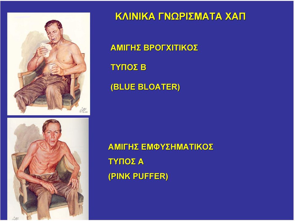 (BLUE BLOATER) ΑΜΙΓΗΣ