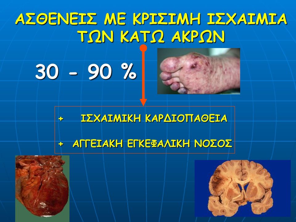 30-90 % + ΙΣΧΑΙΜΙΚΗ