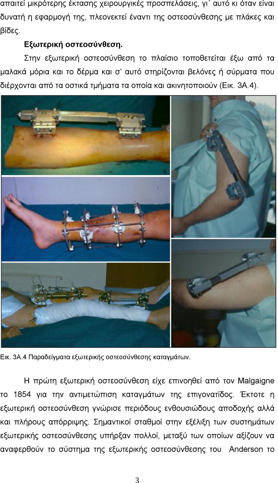 3Α.4). Εικ. 3Α.4 Παραδείγµατα εξωτερικής οστεοσύνθεσης καταγµάτων. Η πρώτη εξωτερική οστεοσύνθεση είχε επινοηθεί από τον Malgaigne το 1854 για την αντιµετώπιση καταγµάτων της επιγονατίδος.