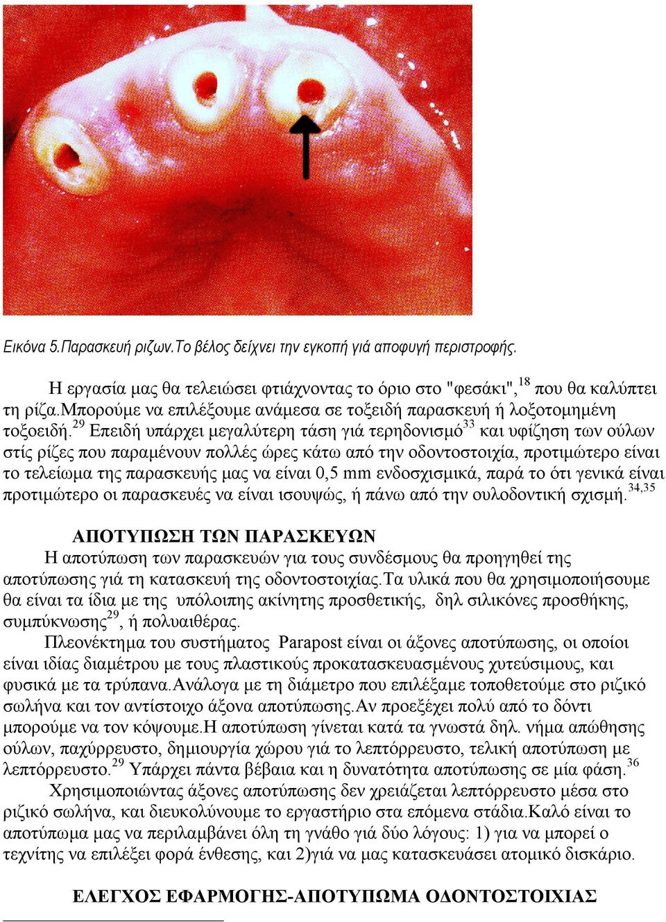 29 Επειδή υπάρχει µεγαλύτερη τάση γιά τερηδονισµό 33 και υφίζηση των ούλων στίς ρίζες που παραµένουν πολλές ώρες κάτω από την οδοντοστοιχία, προτιµώτερο είναι το τελείωµα της παρασκευής µας να είναι