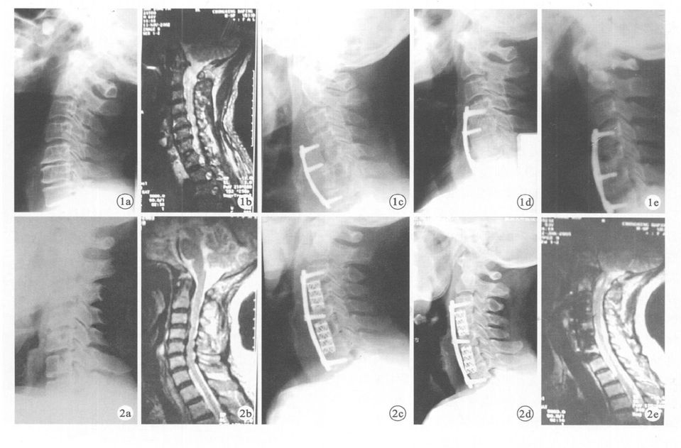 X2ray film on the 2nd day after the revision surgery et he X2ray film 6 month s after the revision surgeryf ig.