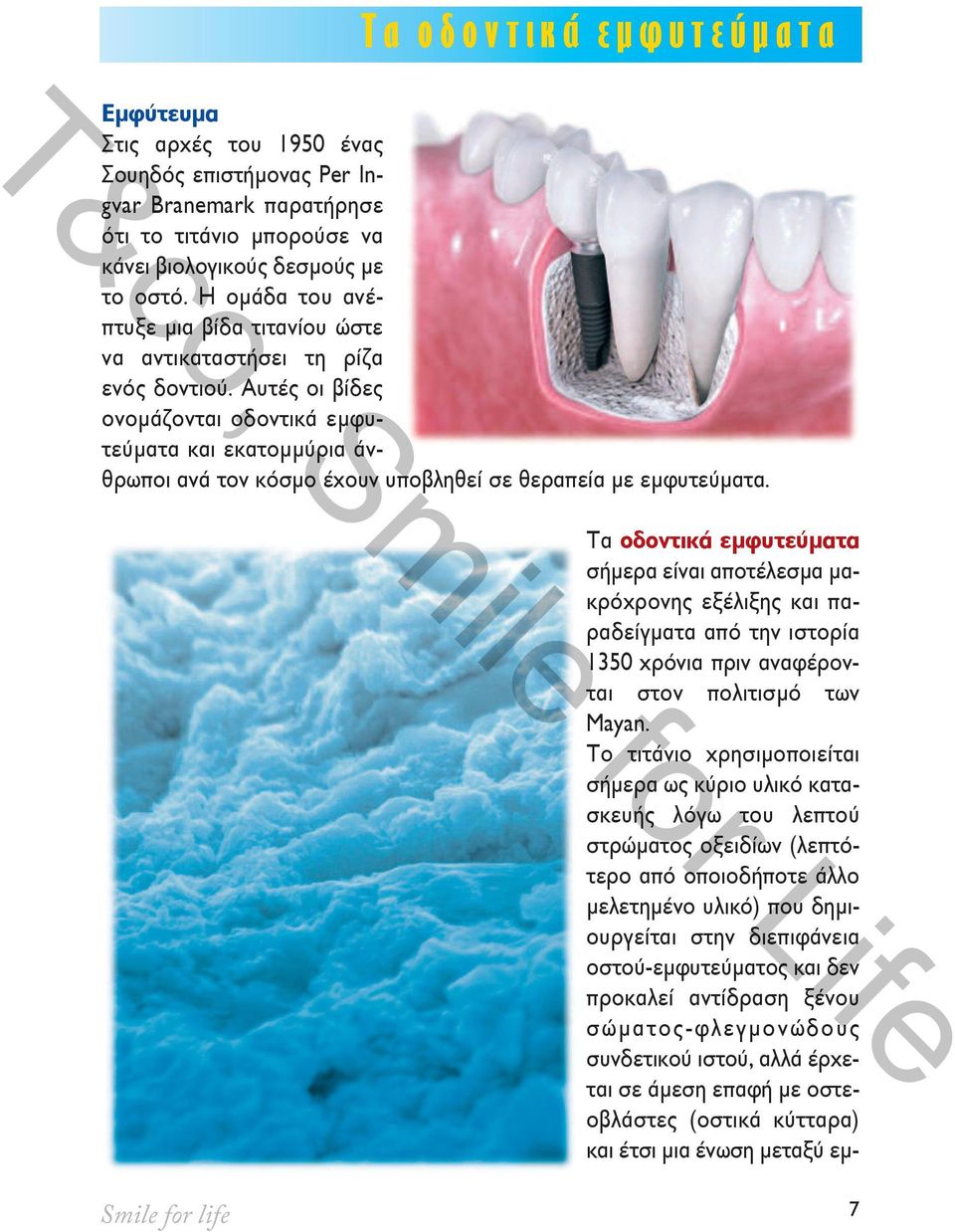 Αυτές οι βίδες ονομάζονται οδοντικά εμφυτεύματα και εκατομμύρια άνθρωποι ανά τον κόσμο έχουν υποβληθεί σε θεραπεία με εμφυτεύματα.