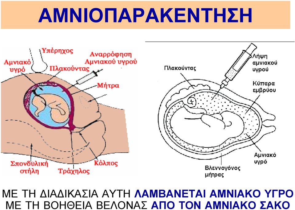 ΑΜΝΙΑΚΟ ΥΓΡΟ ΜΕ ΤΗ ΒΟΗΘΕΙΑ