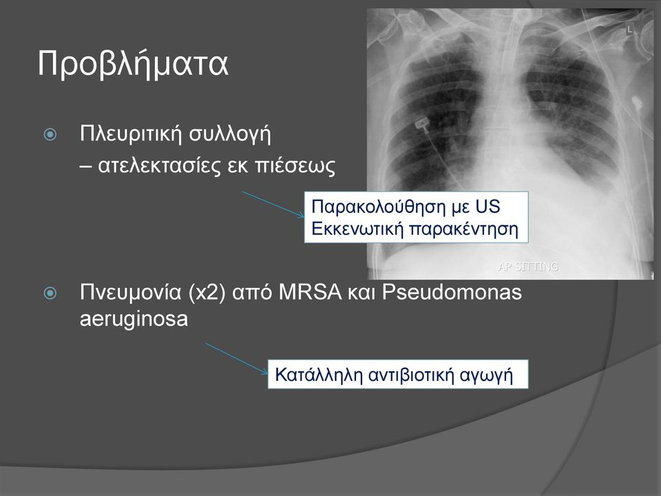 παρακέντηση Πνευμονία (x2) από MRSA και