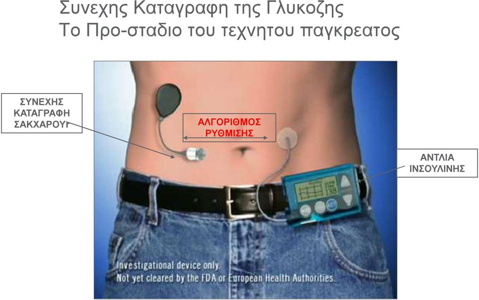παγκρεατος ΣΥΝΕΧΗΣ ΚΑΤΑΓΡΑΦΗ